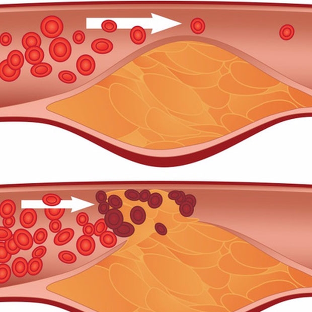 Mạch máu xấu - Nguyên nhân của bệnh tật và sự suy giảm tuổi thọ