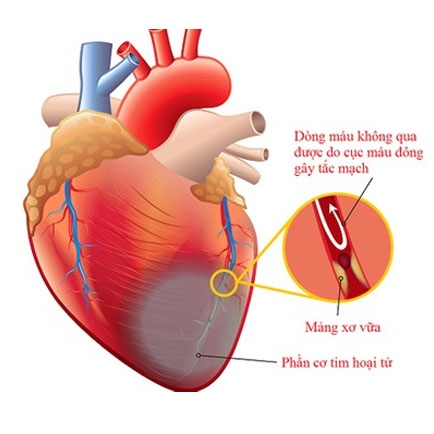 Sự khác biệt giữa đột quỵ và nhồi máu cơ tim