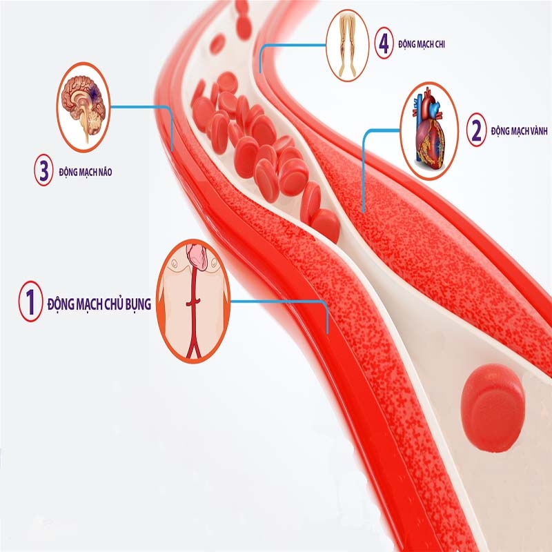 Xơ vữa động mạch: Nguyên nhân, triệu chứng, chẩn đoán và điều trị